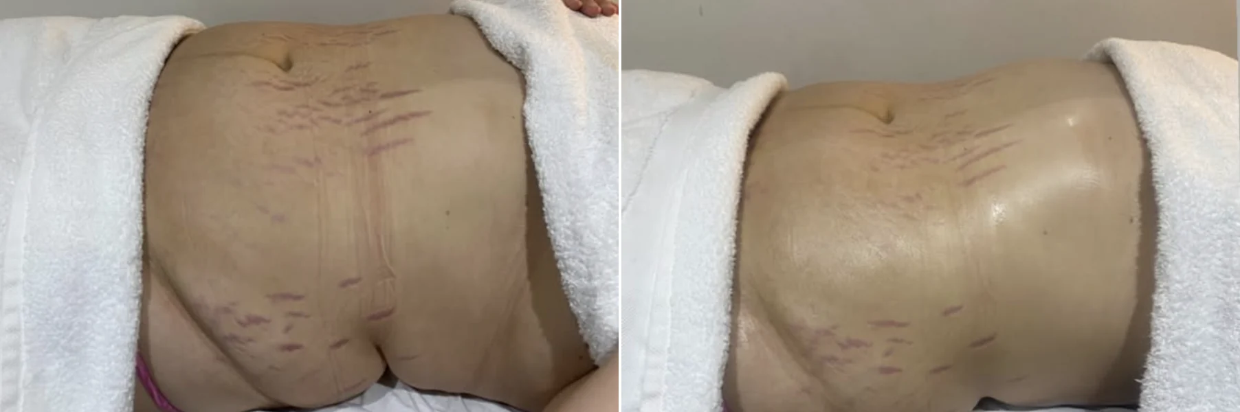 Stomach before and after a single lymphatic drainage session