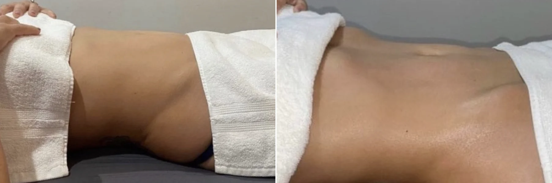 Waist before and after a drainage session