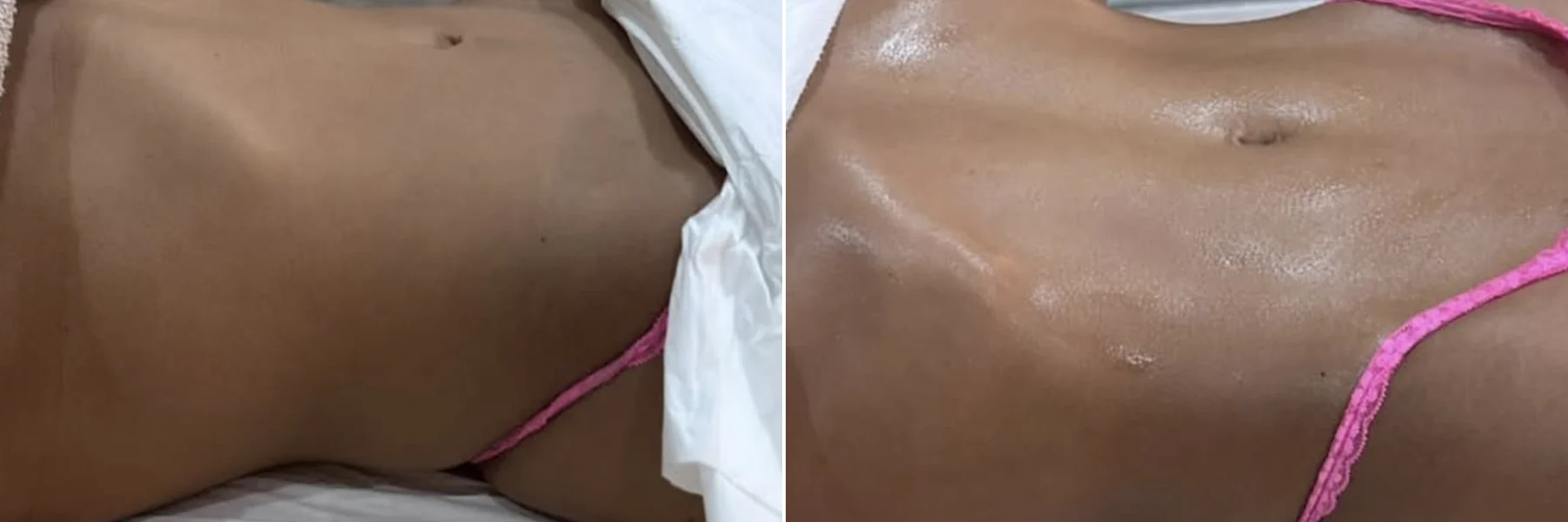 Abdomen before and after lymphatic drainage