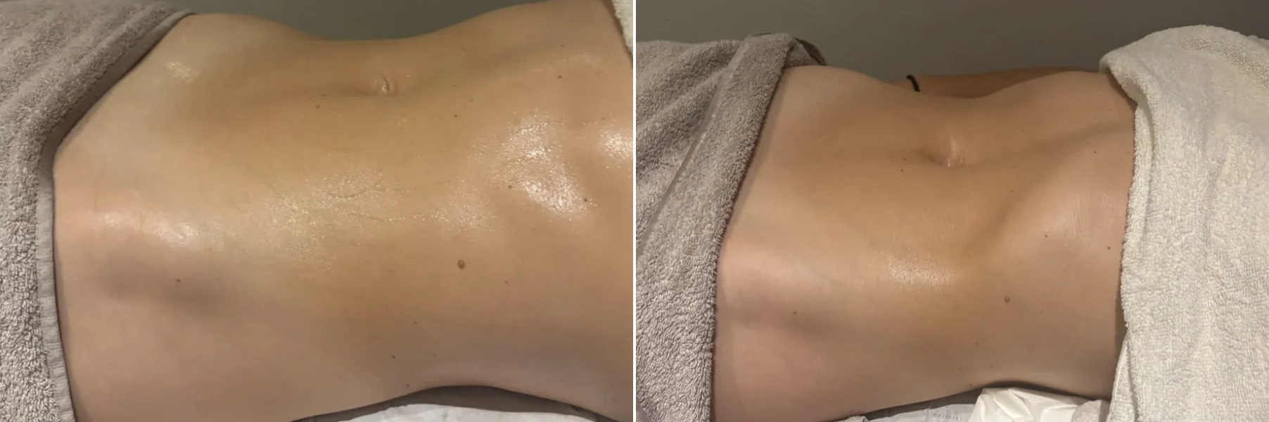 Stomach before and after a drainage session