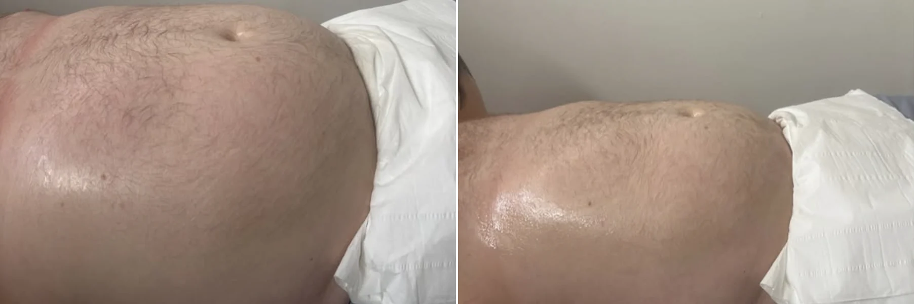 Male abdomen before and after lymphatic drainage