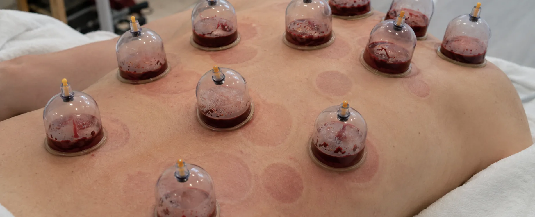 Cupping therapy session at Liverpool Cupping in Huyton
