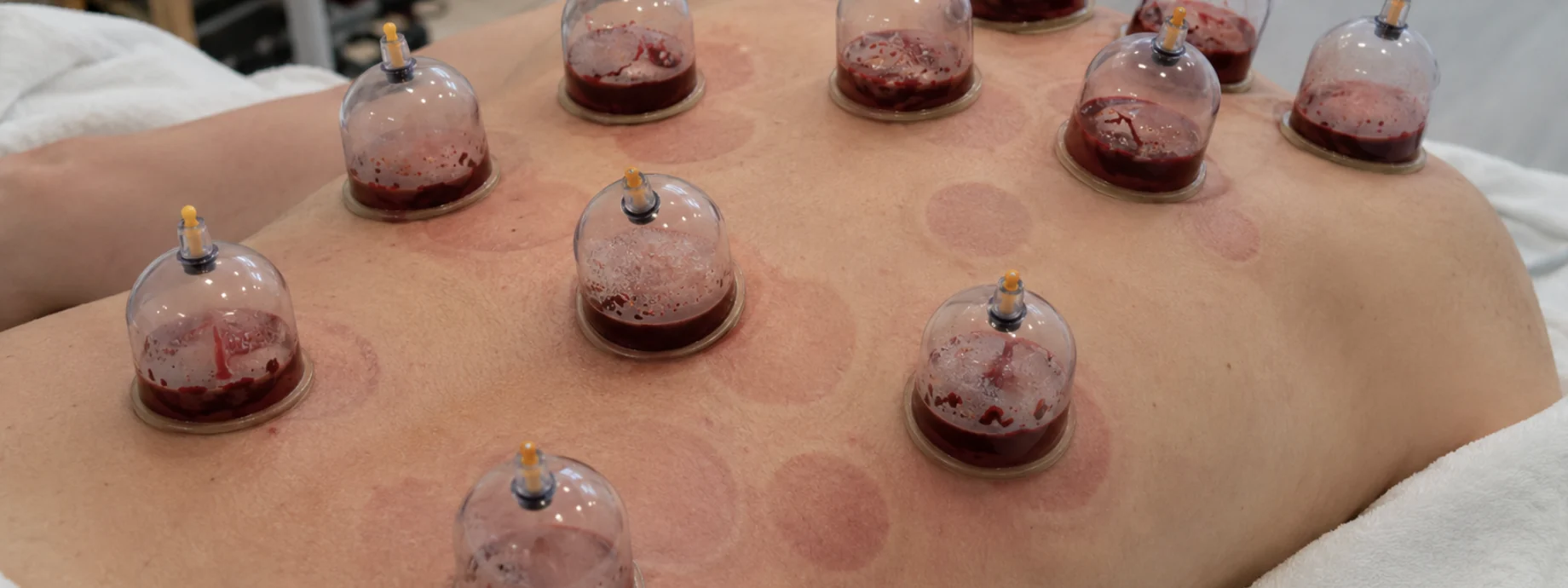 Cupping therapy session at Liverpool Cupping