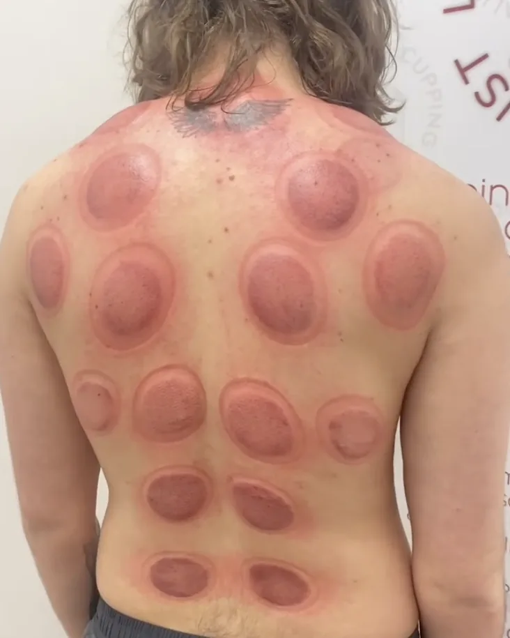 Even cupping marks down both sides of the spine