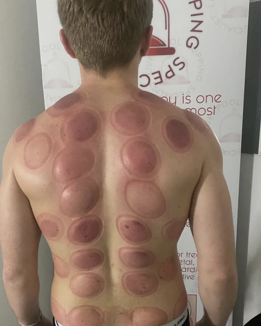 Cupping marks photographed against the Liverpool Cupping banner