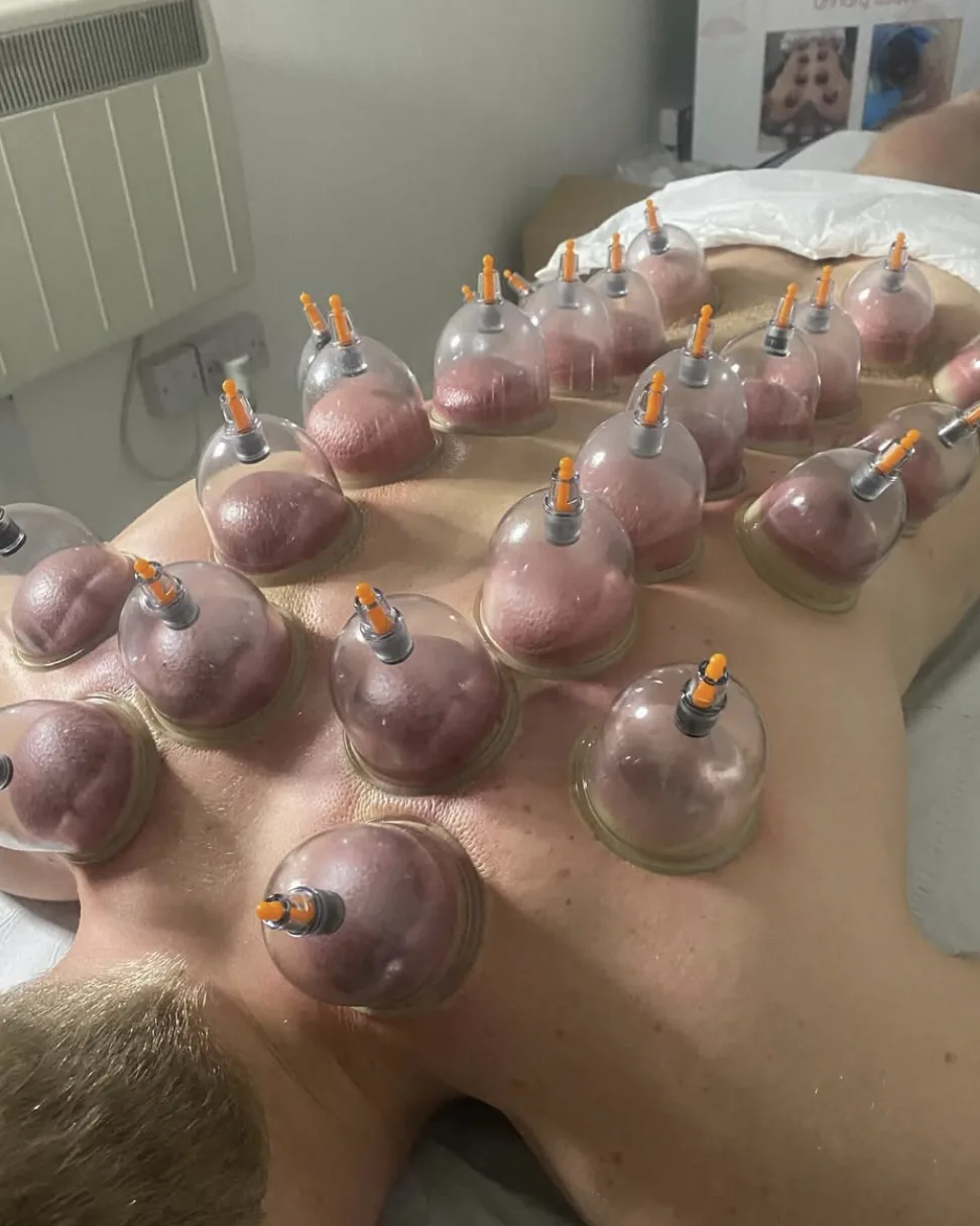 Cupping treatment demonstration during training at Liverpool Cupping