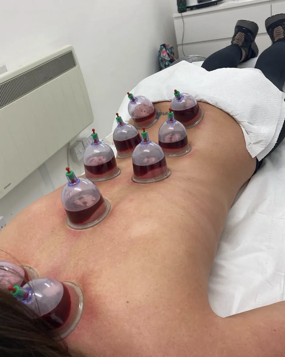 Wet cupping session on a client's lower back