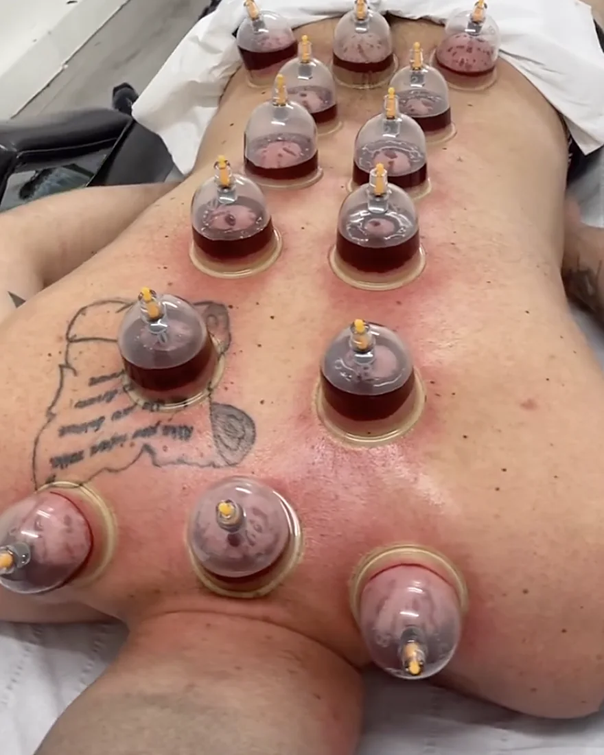 Wet cupping placed across a client's back and legs at the Huyton clinic